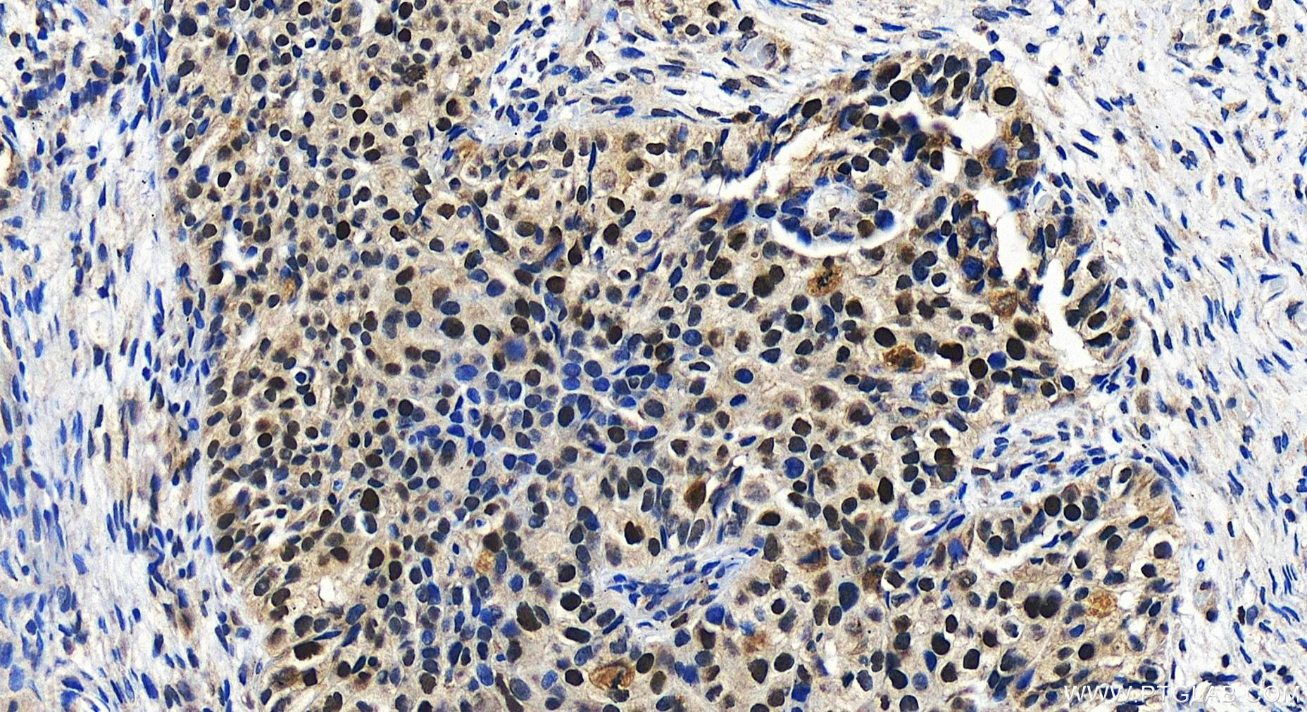 IHC staining of human ovary cancer using 27633-1-AP