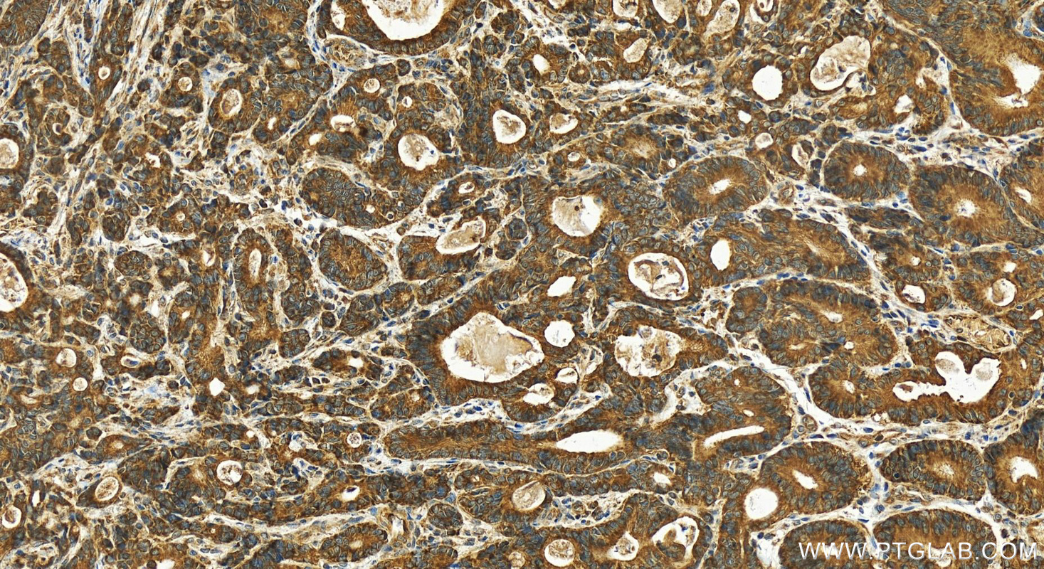 IHC staining of human stomach cancer using 11728-1-AP