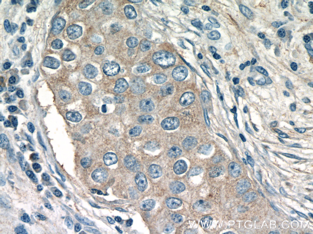 IHC staining of human breast cancer using 19537-1-AP