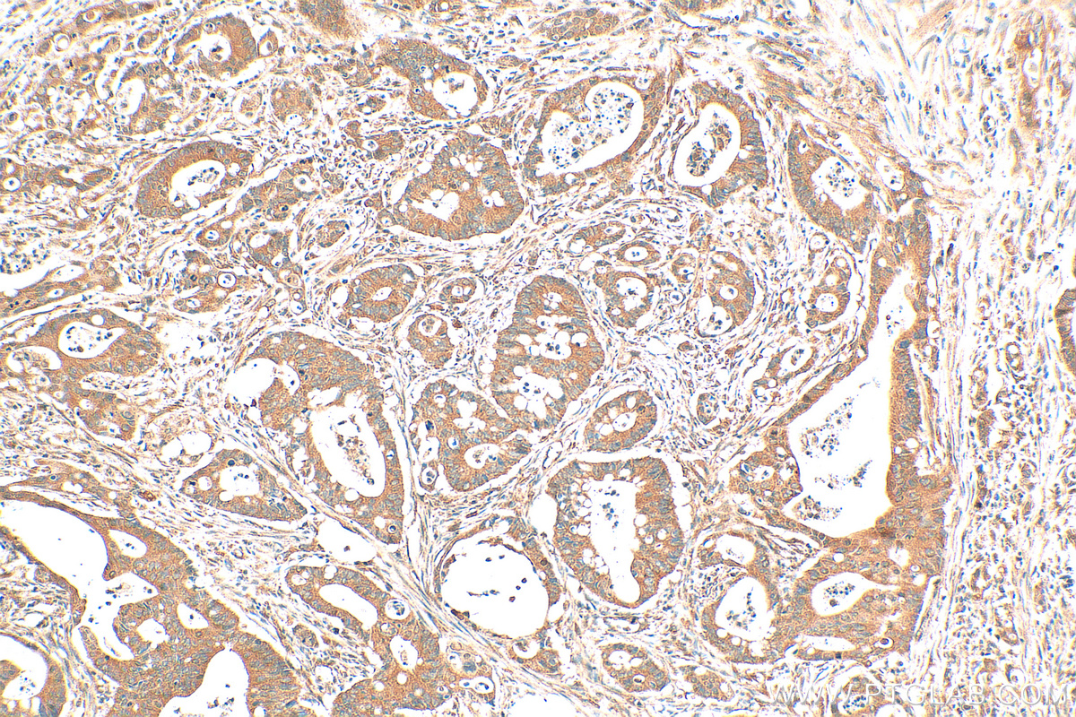 IHC staining of human colon cancer using 16424-1-AP