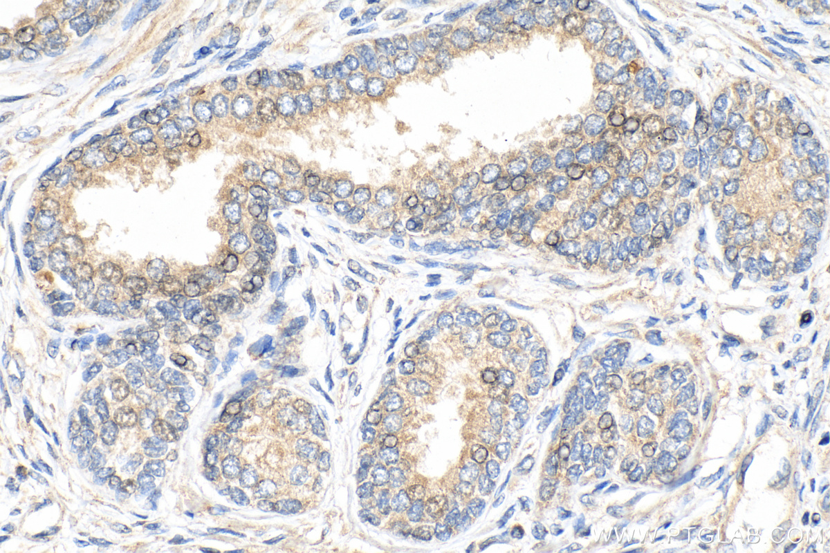 IHC staining of human prostate cancer using 68406-1-Ig (same clone as 68406-1-PBS)