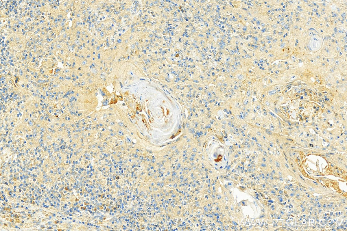 IHC staining of human skin cancer using 15801-1-AP