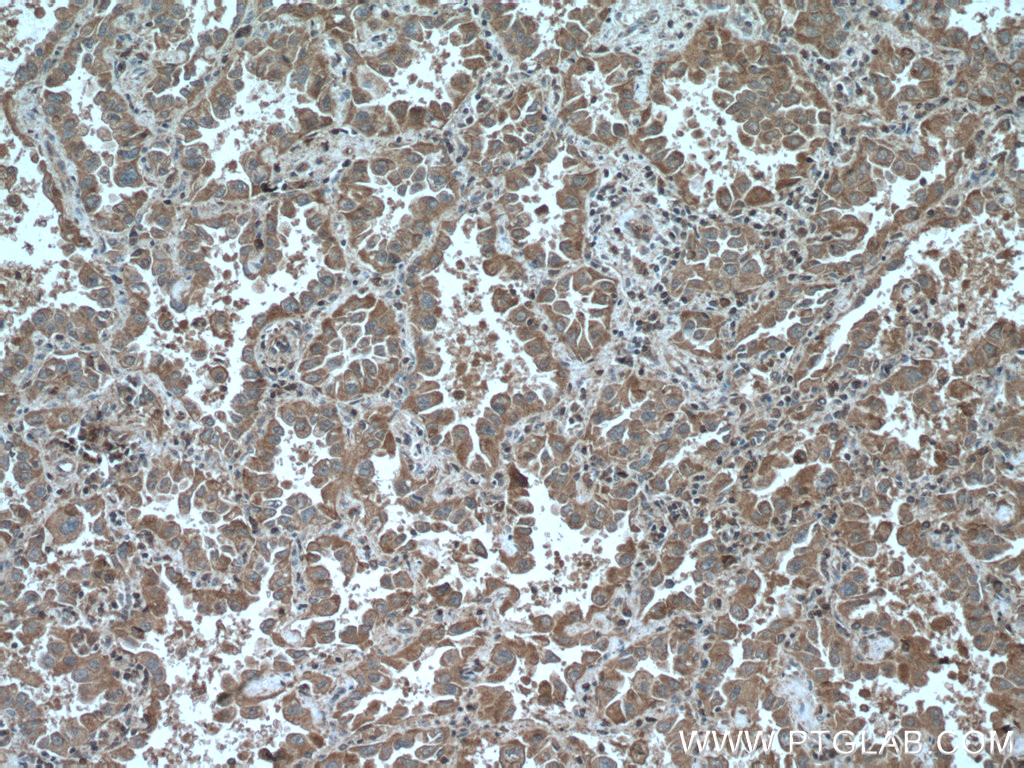 IHC staining of human lung cancer using 66623-1-Ig (same clone as 66623-1-PBS)