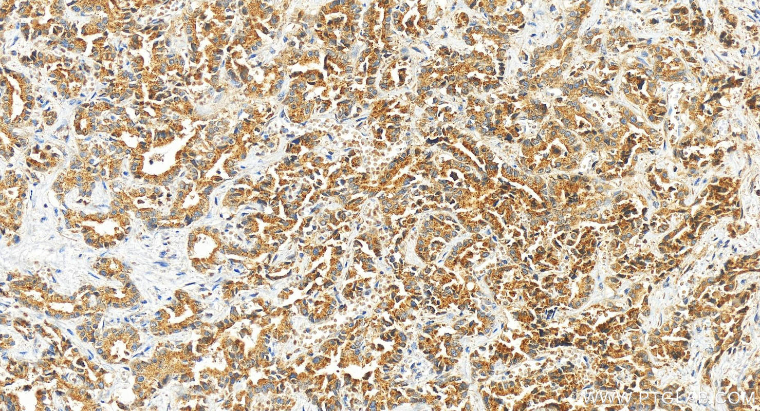 IHC staining of human intrahepatic cholangiocarcinoma using 13135-1-AP