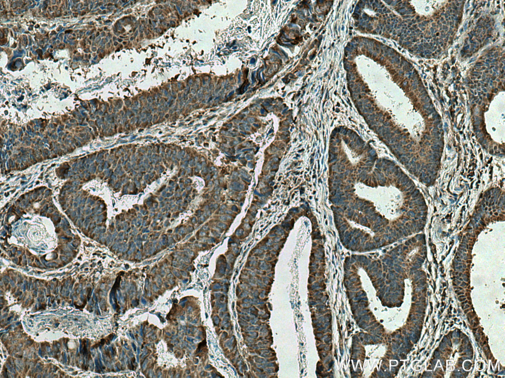 IHC staining of human colon cancer using 12132-1-AP