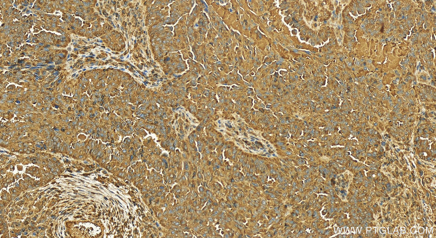 IHC staining of human ovary cancer using 12132-1-AP