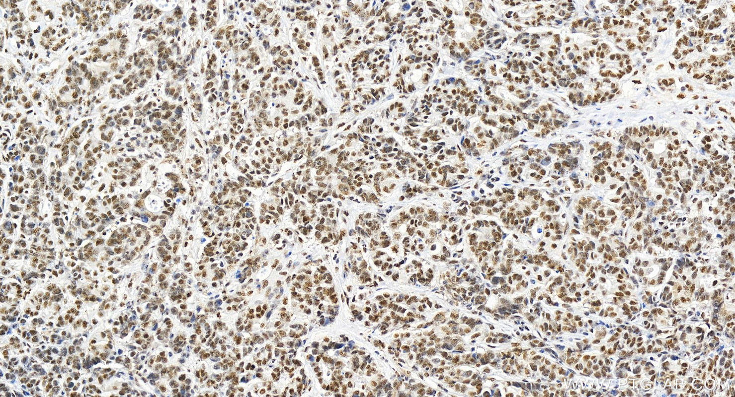 IHC staining of human stomach cancer using 15798-1-AP