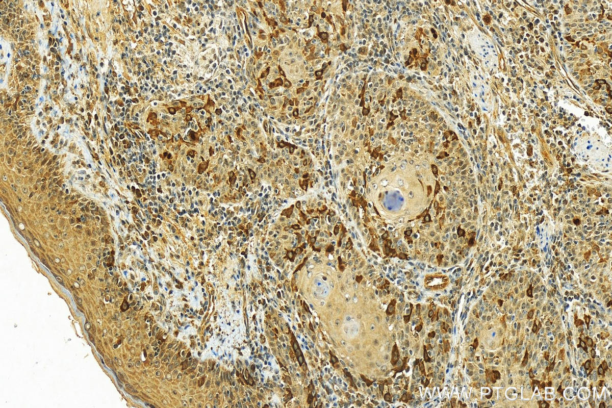 IHC staining of human skin cancer using 25486-1-AP