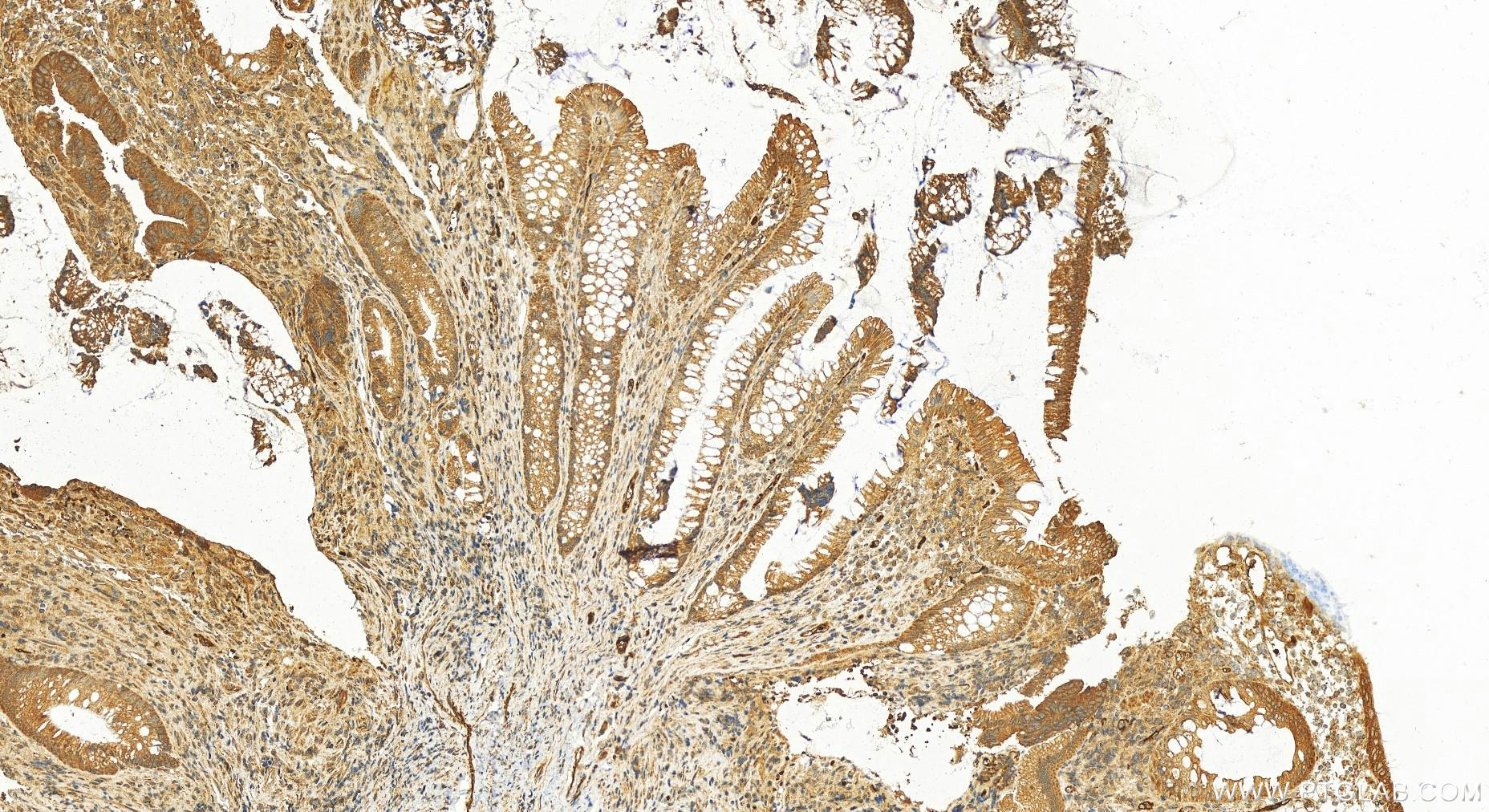 IHC staining of human colon  cancer using 17143-1-AP