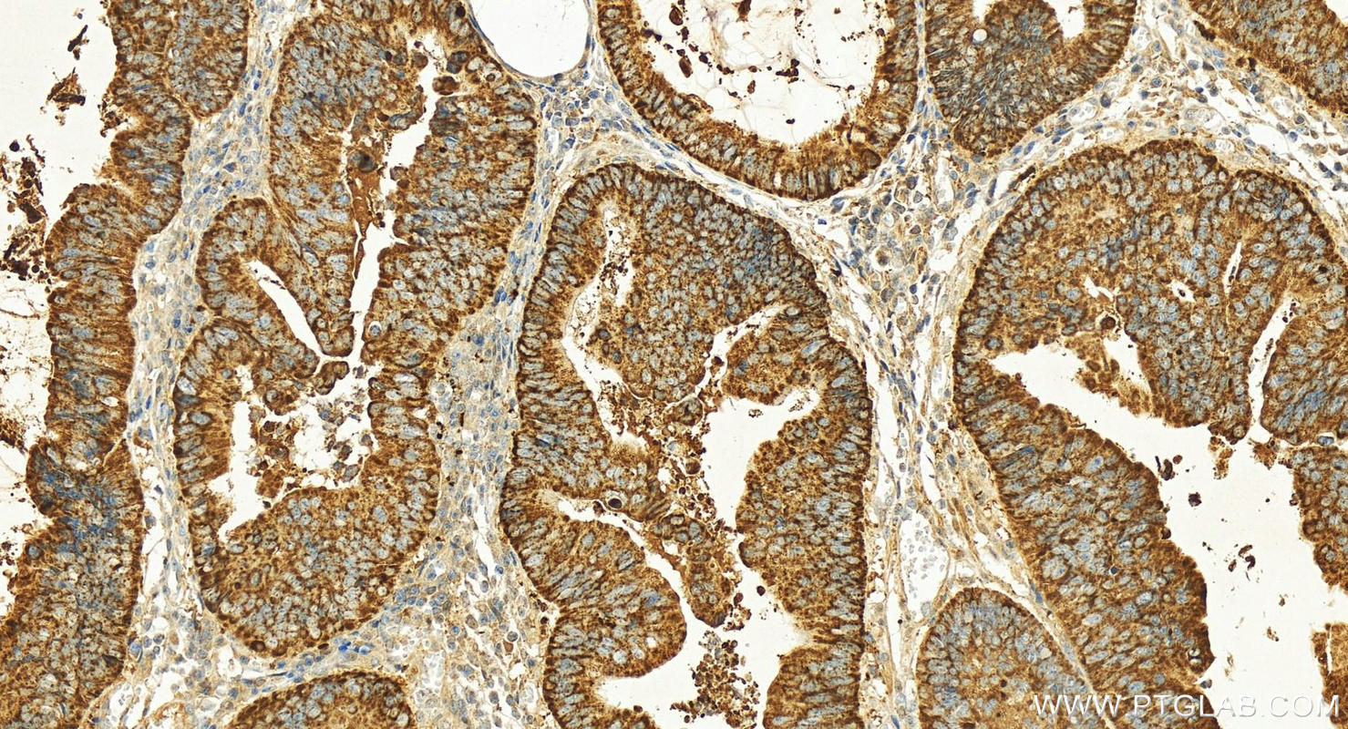 IHC staining of human colon cancer using 15346-1-AP