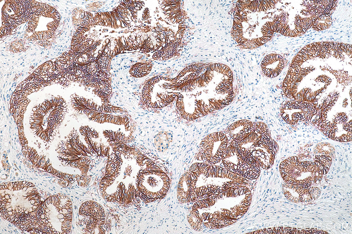 IHC staining of human pancreas cancer using 66167-1-Ig