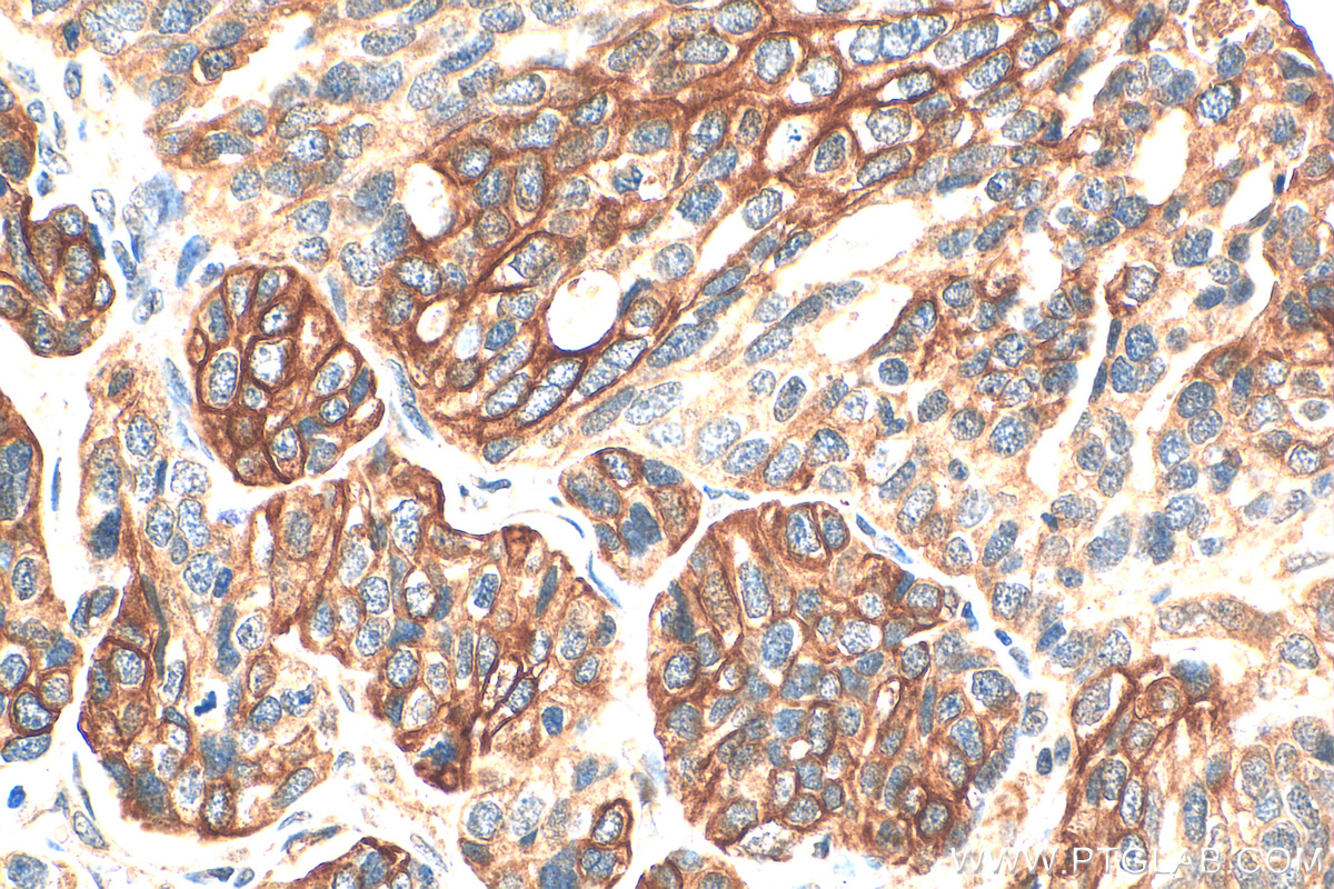 IHC staining of human ovary tumor using 16195-1-AP