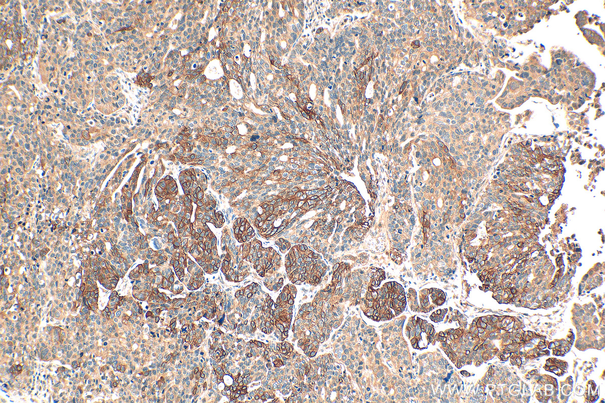 IHC staining of human ovary tumor using 16195-1-AP