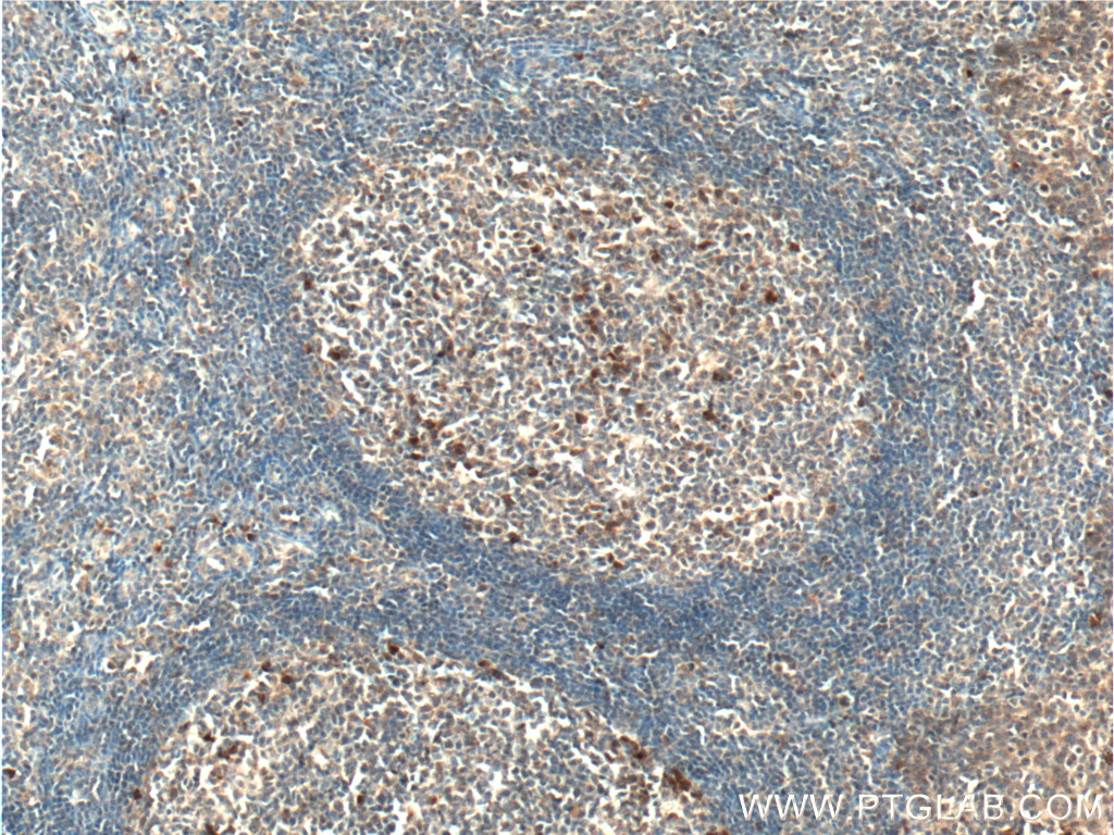 IHC staining of human tonsillitis using 26257-1-AP