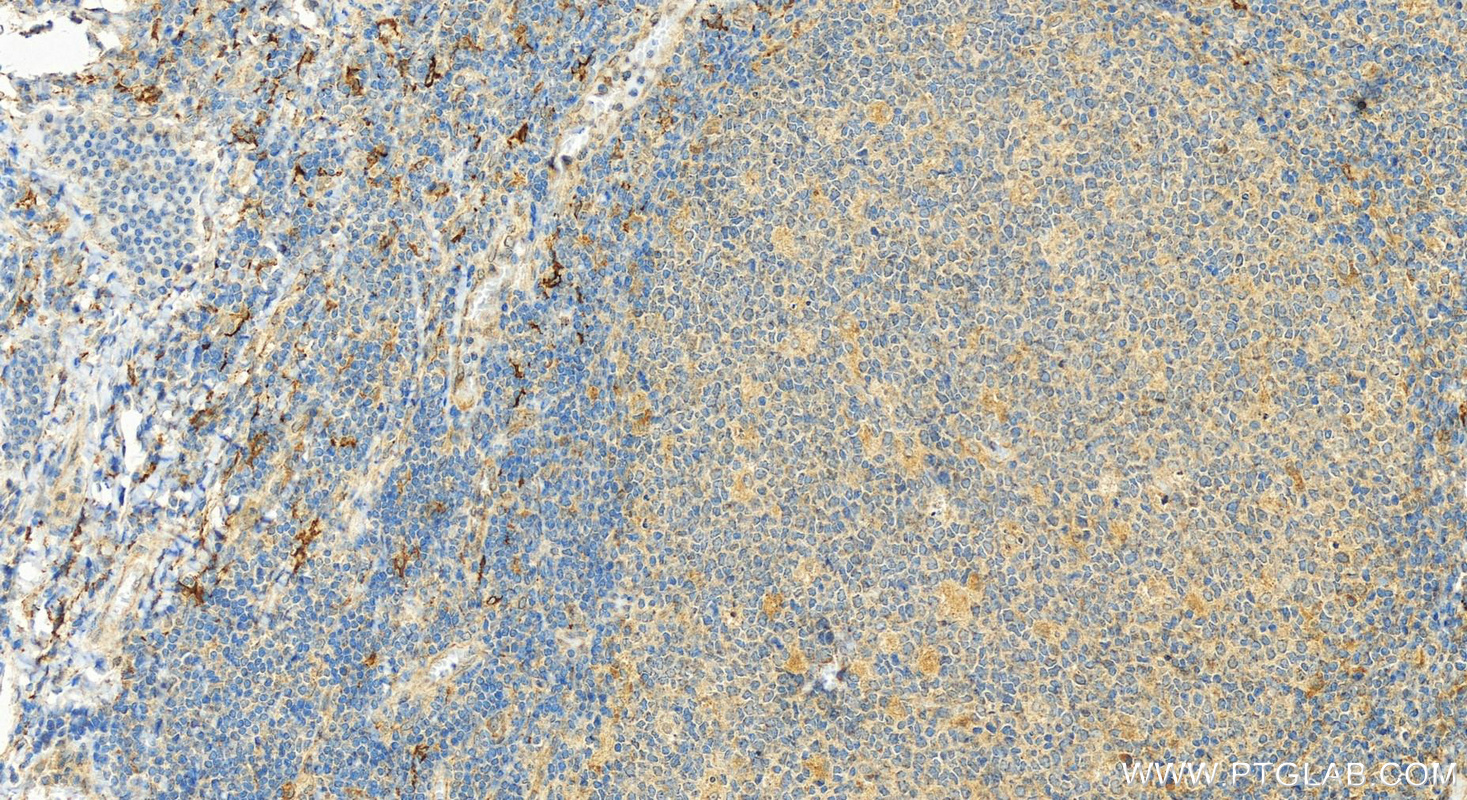 IHC staining of human tonsillitis using 22003-1-AP