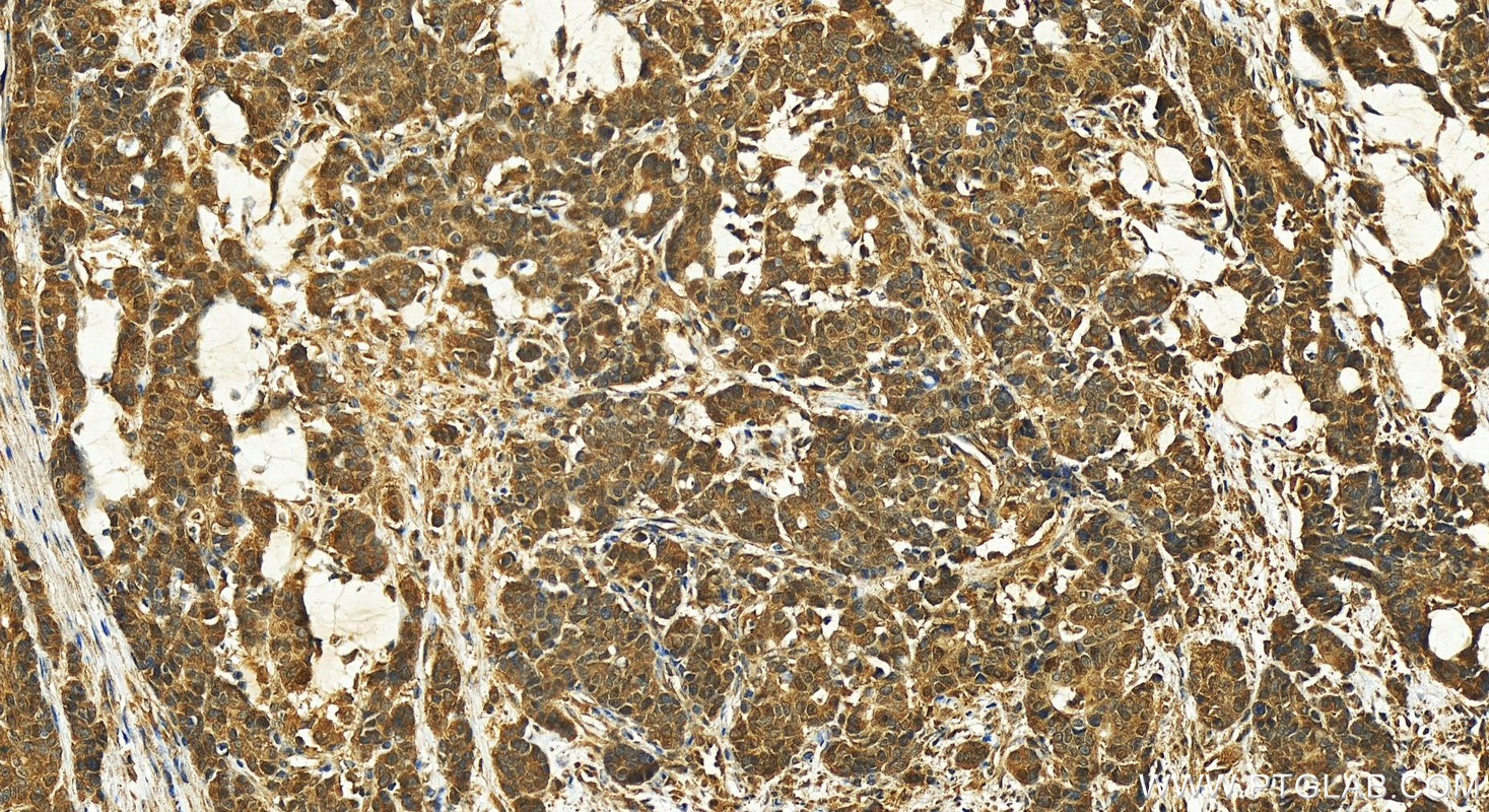 IHC staining of human stomach cancer using 23206-1-AP