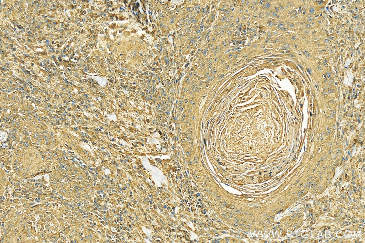 IHC staining of human skin cancer using 10455-1-AP