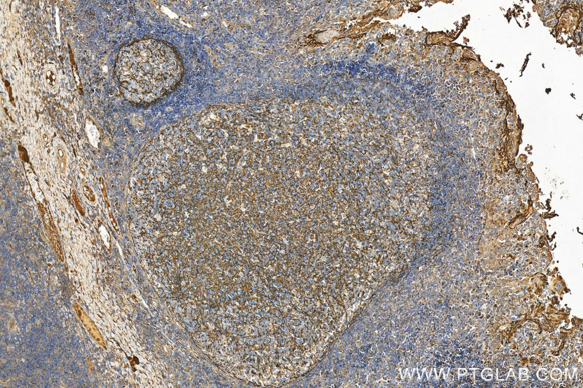 IHC staining of human tonsillitis using 12289-1-AP