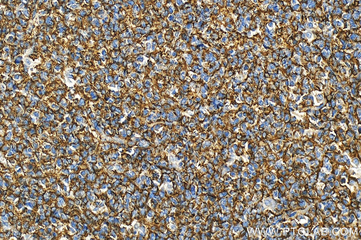 IHC staining of human tonsillitis using 12289-1-AP