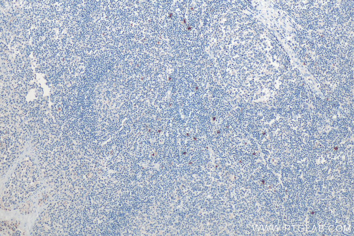 IHC staining of human tonsillitis using 18189-1-AP