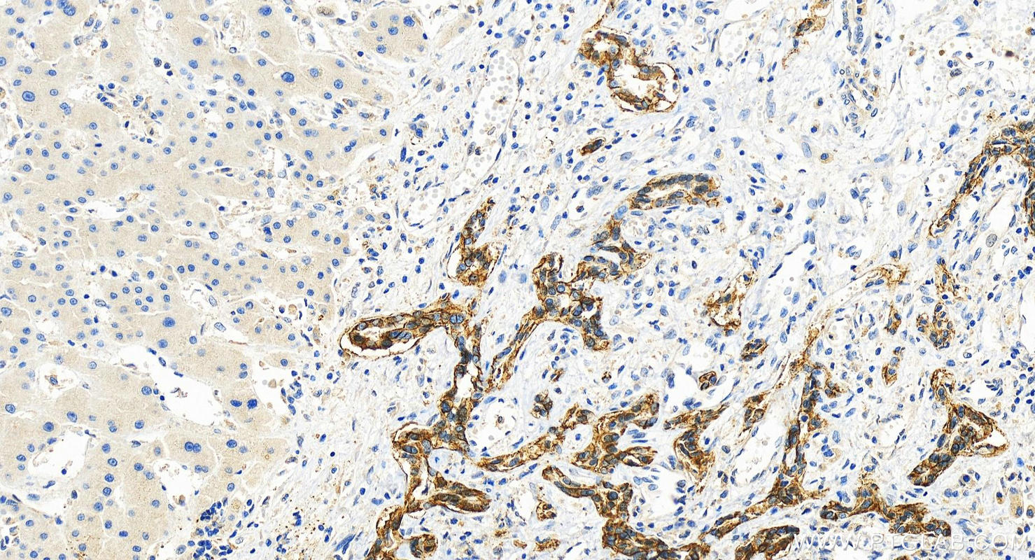 IHC staining of human intrahepatic cholangiocarcinoma using 83381-1-RR (same clone as 83381-1-PBS)