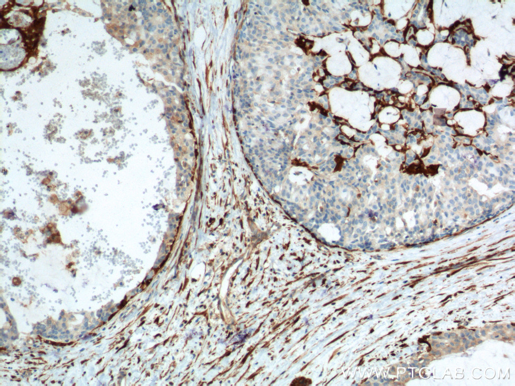 IHC staining of human breast hyperplasia using 66244-1-Ig