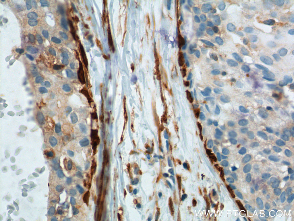 IHC staining of human breast hyperplasia using 66244-1-Ig