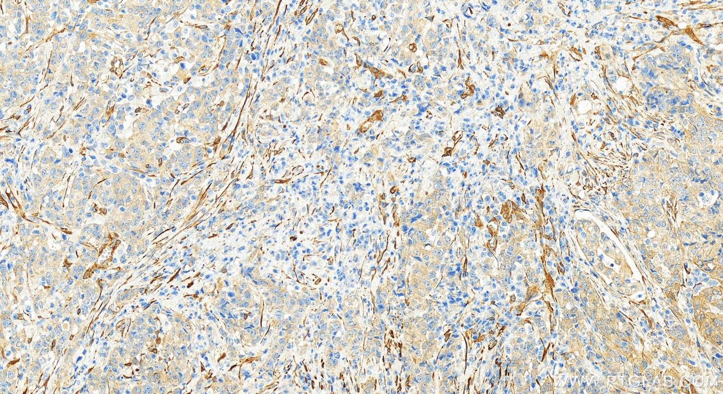 IHC staining of human stomach cancer using 11509-1-AP