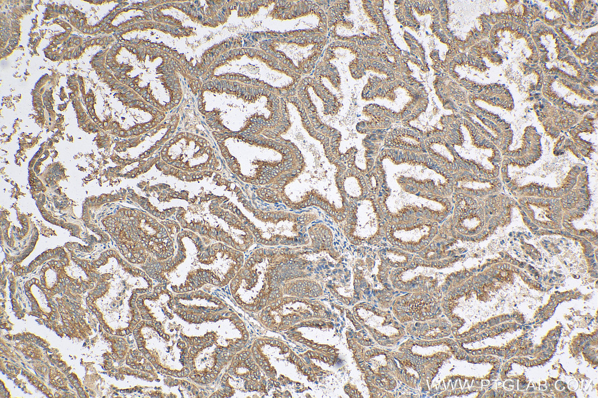 IHC staining of human ovary tumor using 10767-1-AP (same clone as 10767-1-PBS)