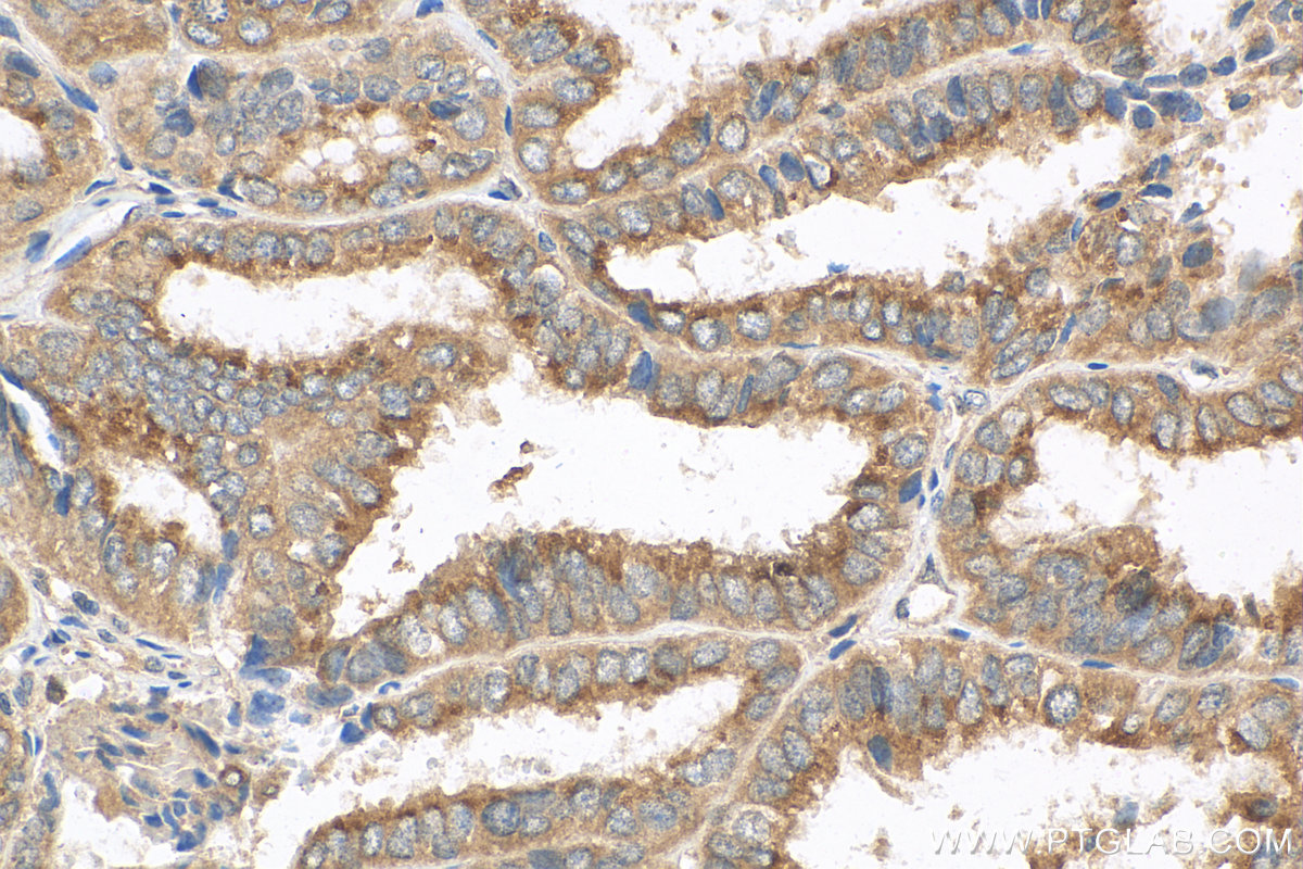 IHC staining of human ovary tumor using 10767-1-AP (same clone as 10767-1-PBS)