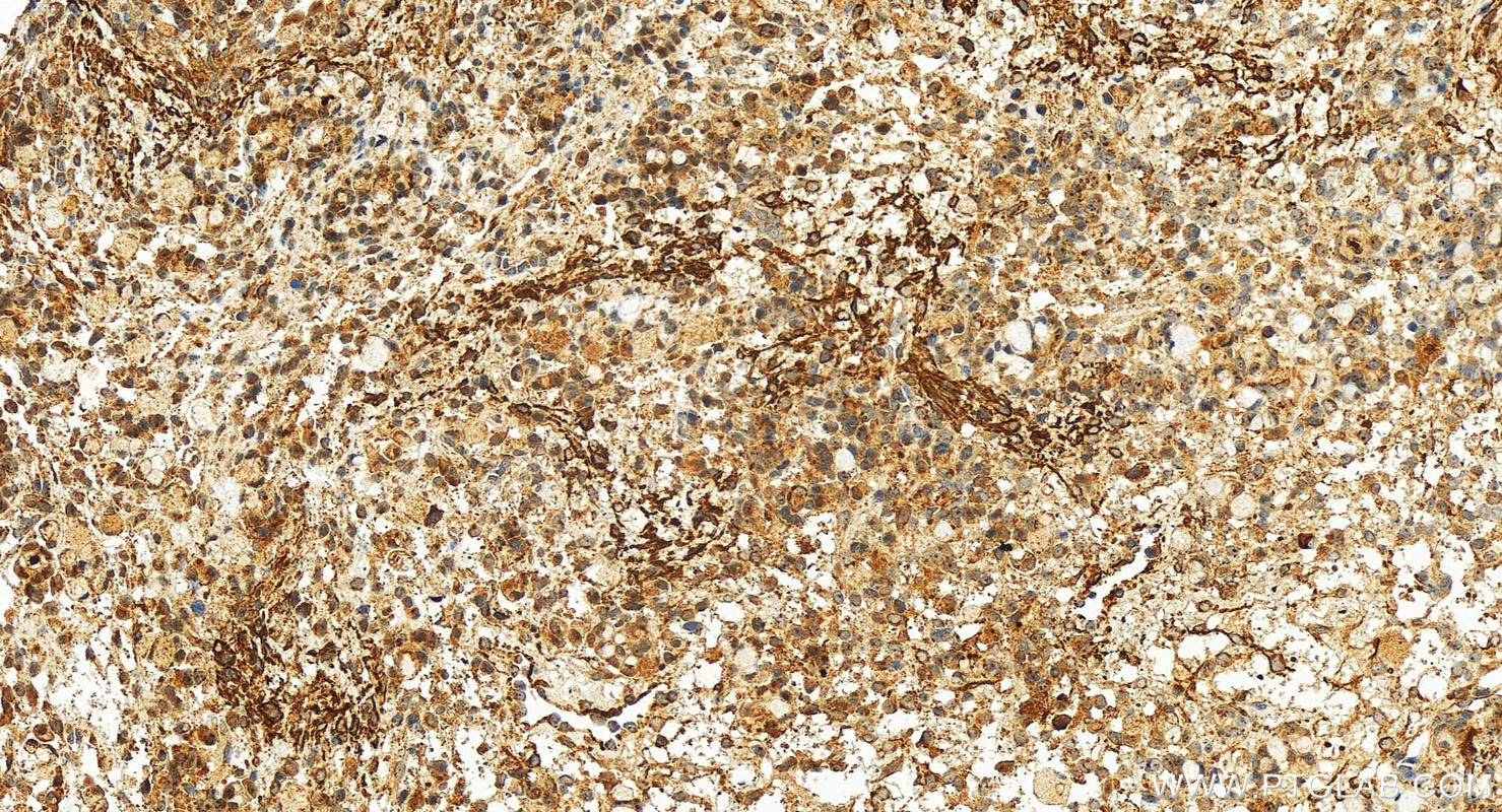 IHC staining of human ovary cancer using 12661-1-AP