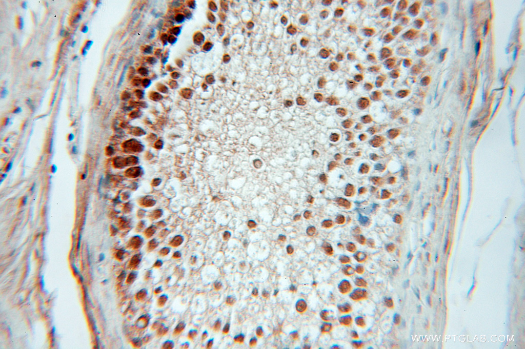 IHC staining of human prostate cancer using 10967-1-AP