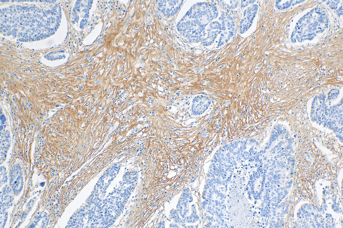 IHC staining of human ovary tumor using 68320-1-Ig (same clone as 68320-1-PBS)