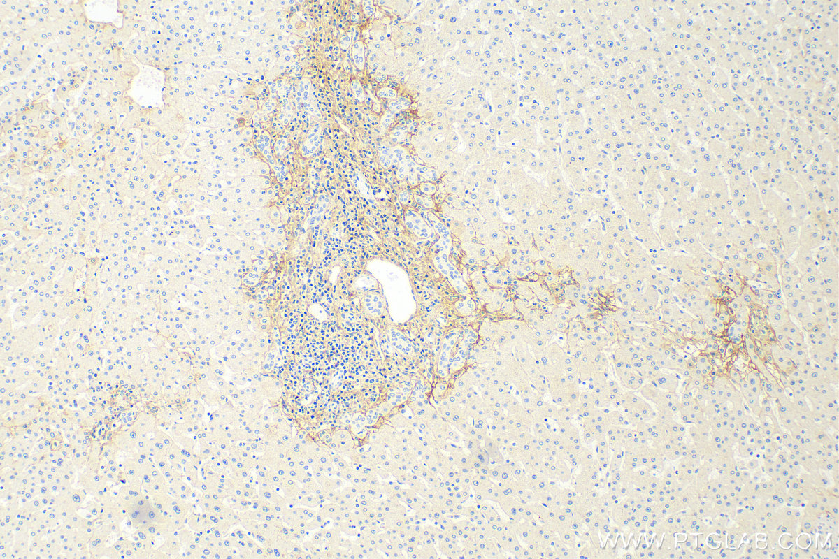 IHC staining of human hepatocirrhosis using 68320-1-Ig (same clone as 68320-1-PBS)