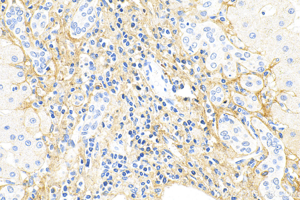 IHC staining of human hepatocirrhosis using 68320-1-Ig (same clone as 68320-1-PBS)