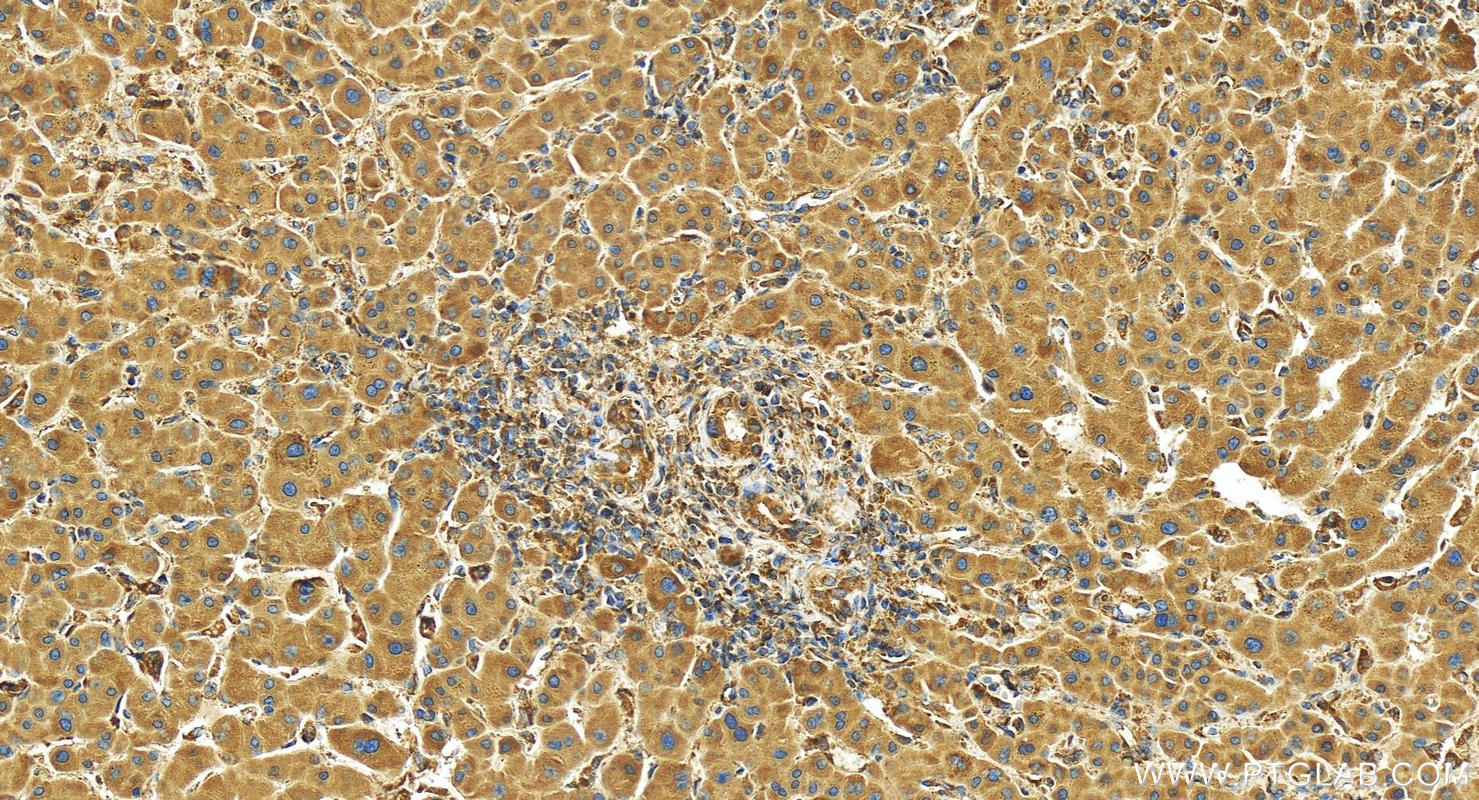 IHC staining of human intrahepatic cholangiocarcinoma using 25237-1-AP