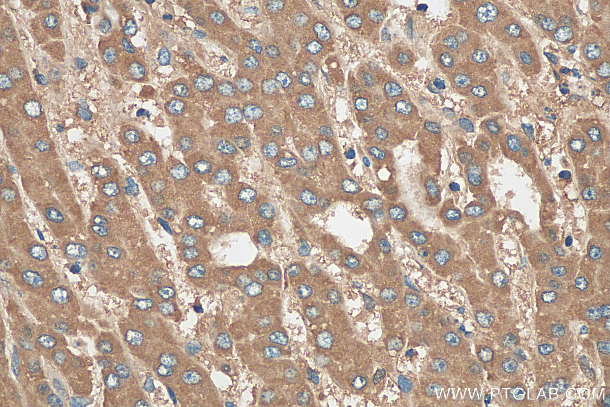 IHC staining of human liver cancer using 28369-1-AP