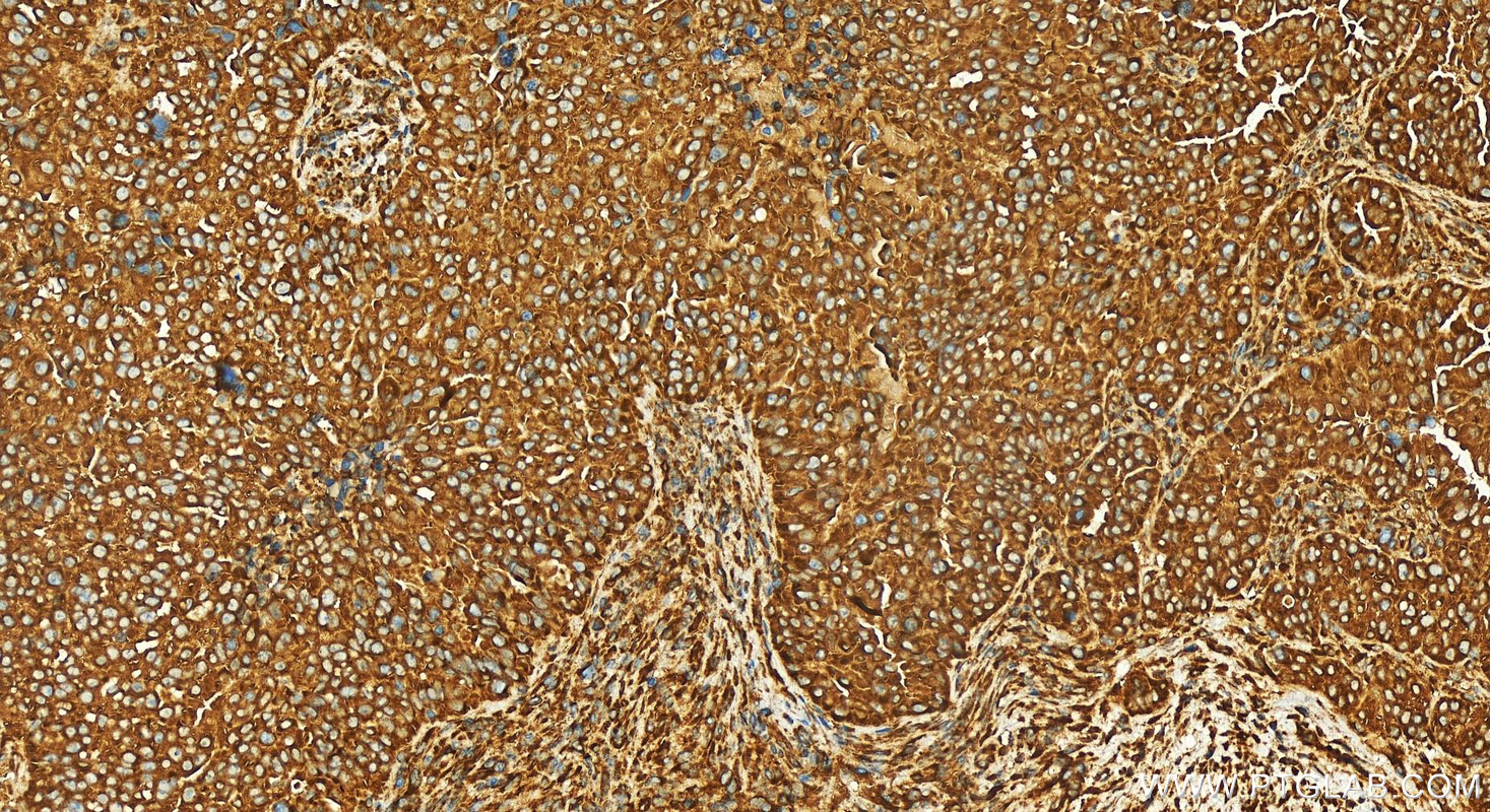 IHC staining of human ovarian  cancer using 83089-2-RR (same clone as 83089-2-PBS)