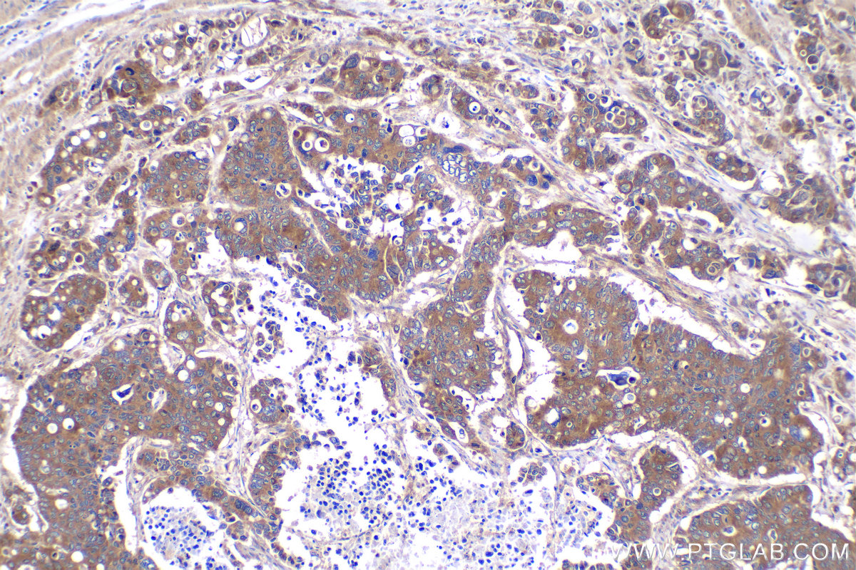 IHC staining of human stomach cancer using 11457-1-AP