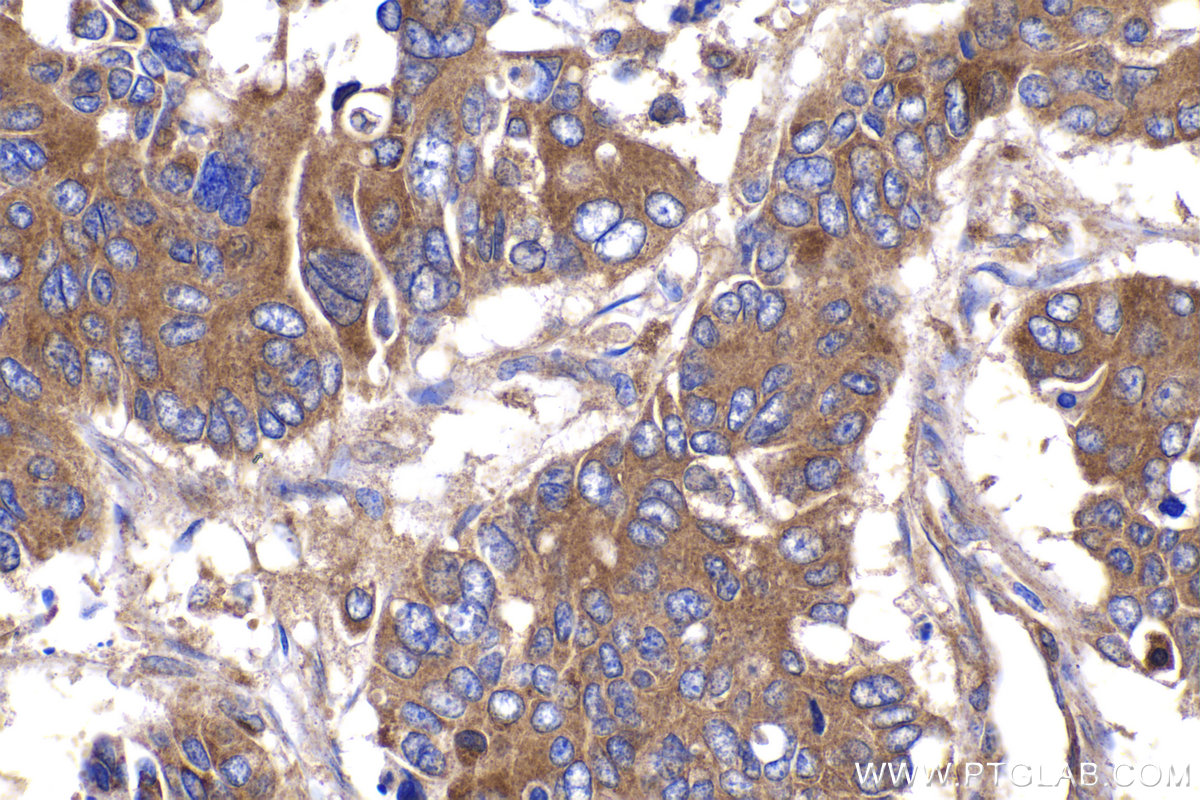 IHC staining of human stomach cancer using 11457-1-AP