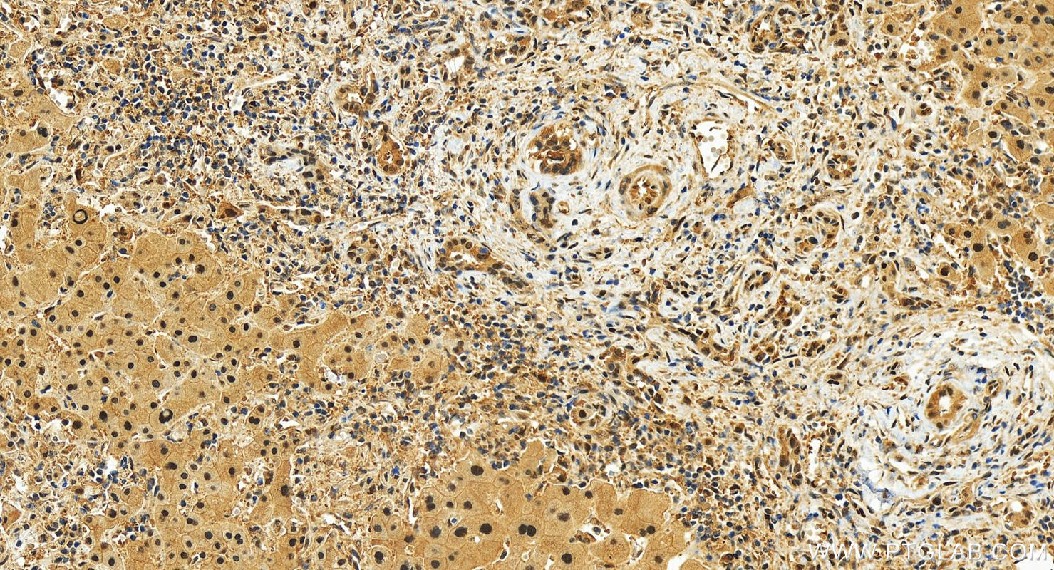 IHC staining of human intrahepatic cholangiocarcinoma using 30494-1-AP