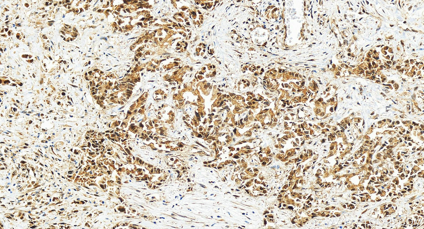 IHC staining of human intrahepatic cholangiocarcinoma using 83312-1-RR