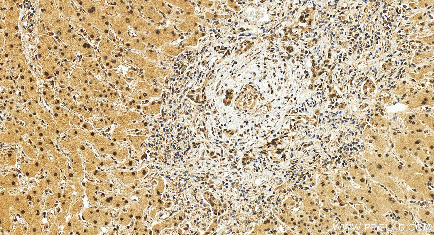 IHC staining of human intrahepatic cholangiocarcinoma using 83312-1-RR