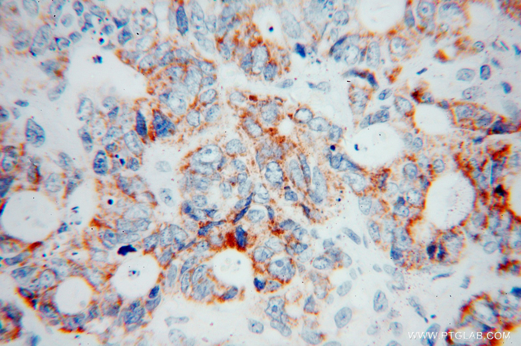 IHC staining of human liver cancer using 15083-1-AP