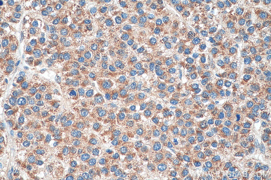 IHC staining of human liver cancer using 14874-1-AP