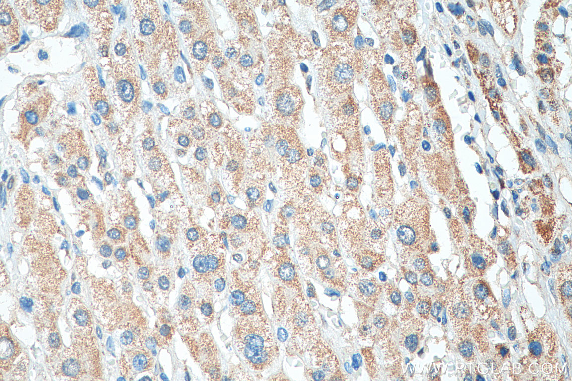 IHC staining of human liver cancer using 14874-1-AP