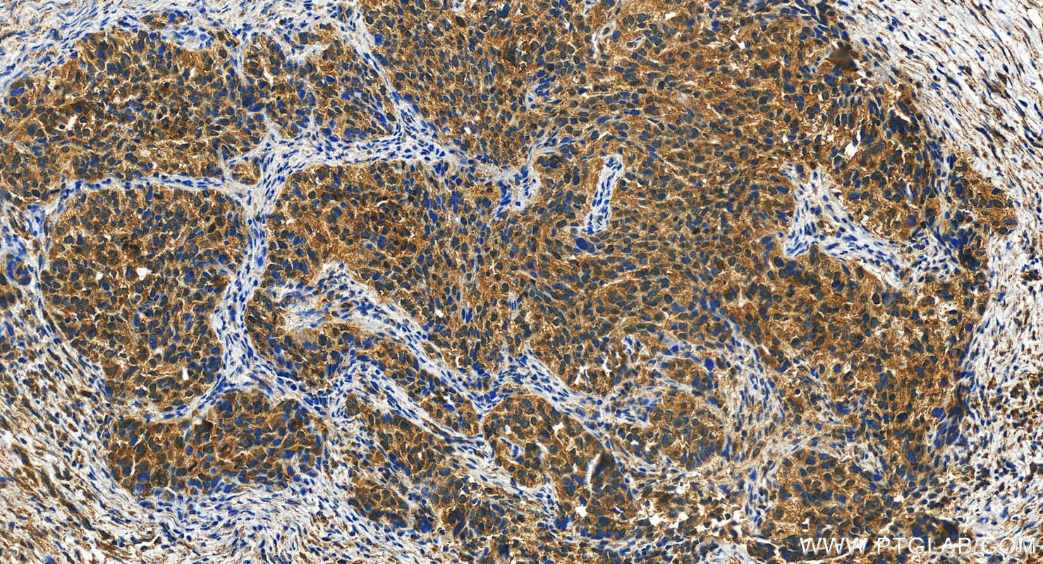 IHC staining of human ovary cancer using 18071-1-AP