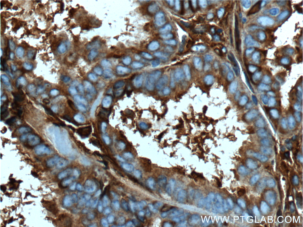 IHC staining of human ovary tumor using 66156-1-Ig