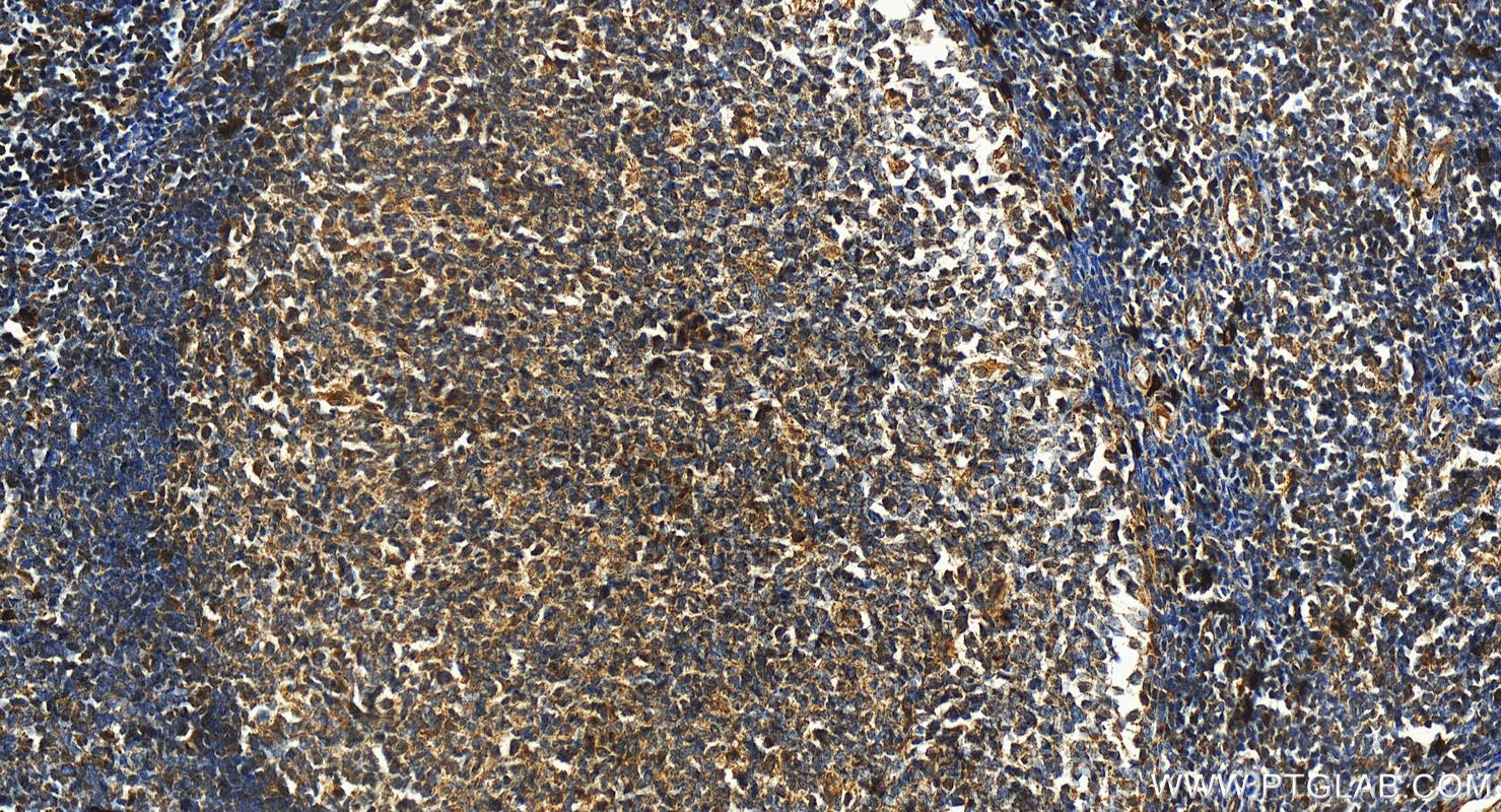 IHC staining of human tonsillitis using 16236-1-AP