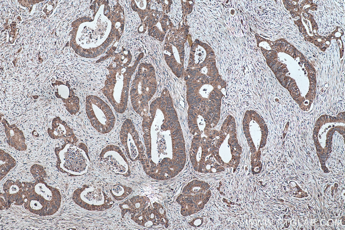 IHC staining of human colon cancer using 10672-1-AP